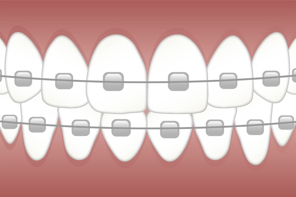 best MMAmouthguard for braces